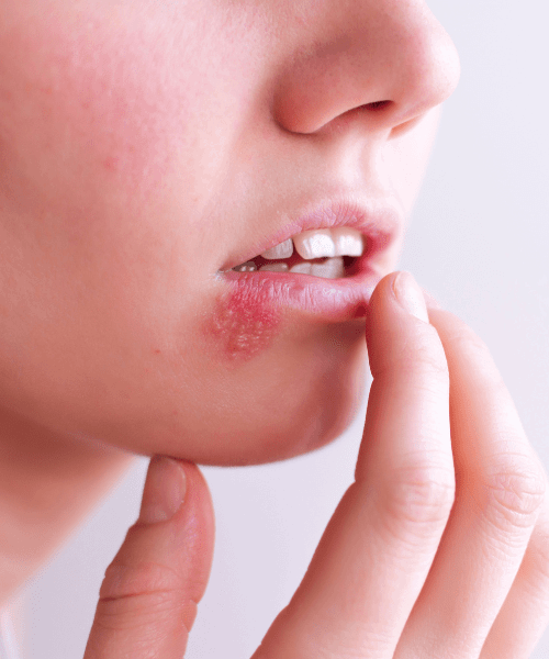 Herpes virus